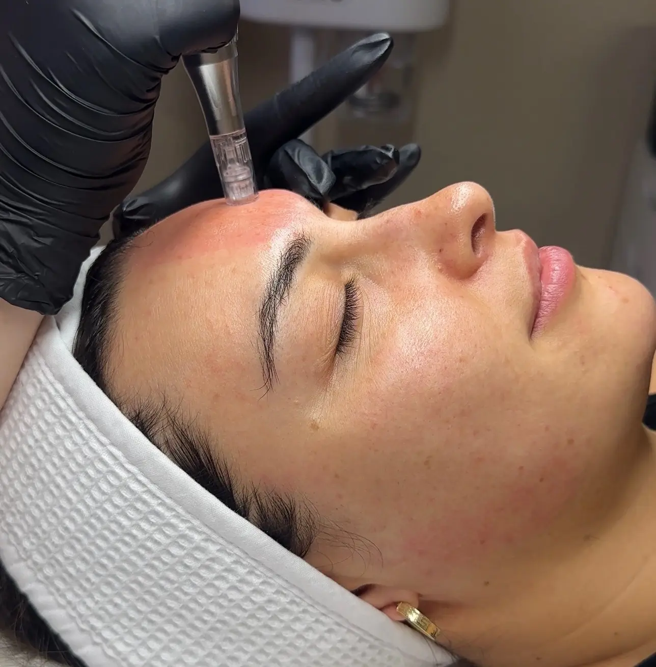 Microneedling treatment at SKIN CARD Clinic