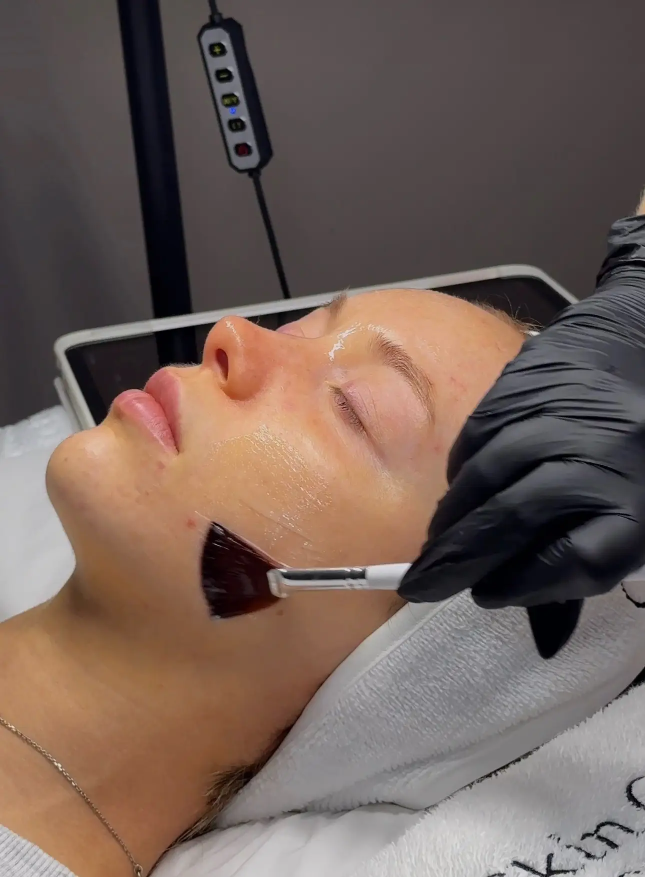 Chemical peel treatment at SKIN CARD Clinic