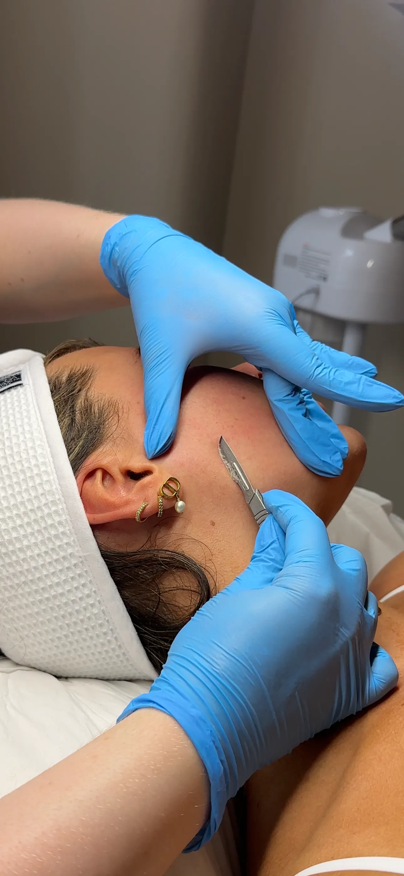 Dermaplaning Treatment at SKIN CARD Clinic