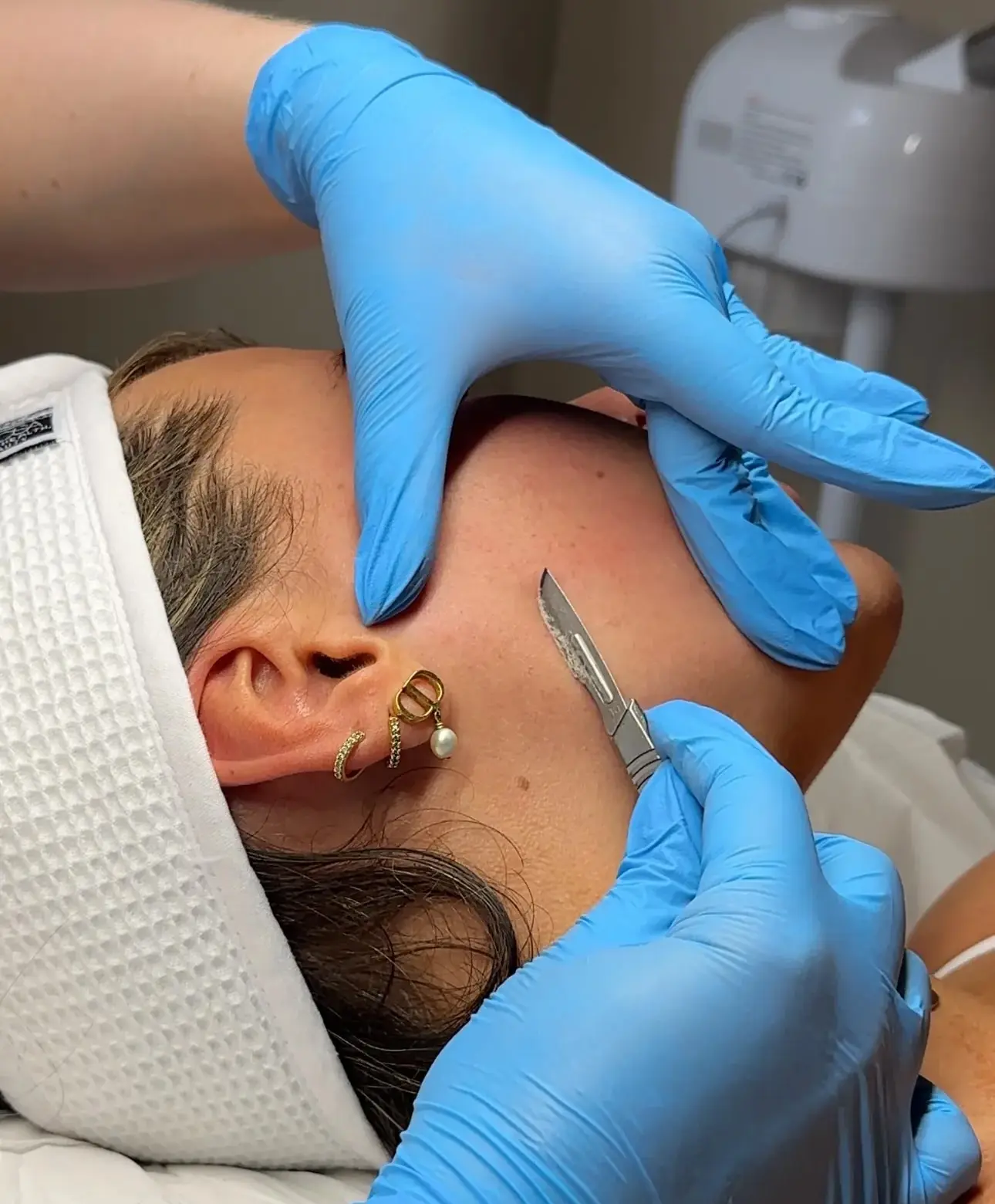 Dermaplaning treatment at SKIN CARD Clinic