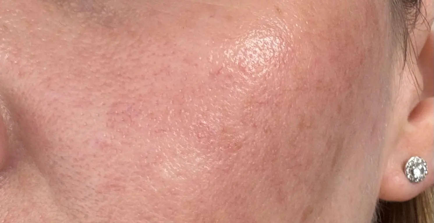 After treatment plan results clear smooth skin